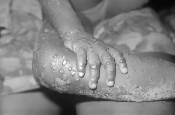 Monkeypox-like lesions are shown on the arm and leg of a female child.