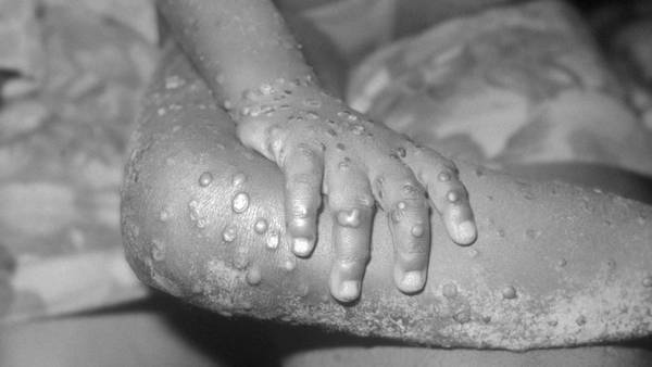 What Is Monkeypox and Should We Be Worried About It?dfd