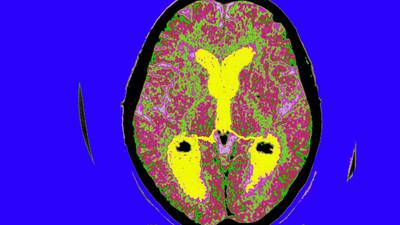 Un medicamento ralentizó el avance del Alzheimer en un estudio a gran escaladfd