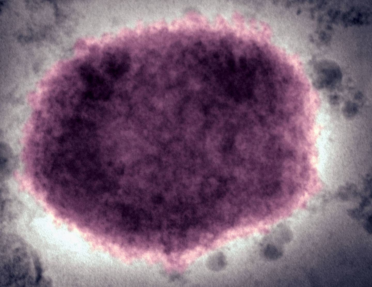 Virus de la viruela del mono en fluido vesicular humanodfd