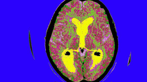 Un medicamento ralentizó el avance del Alzheimer en un estudio a gran escaladfd