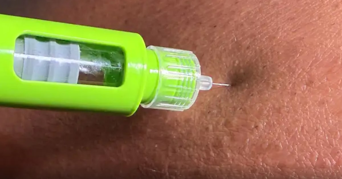 SUS terá caneta emagrecedora GLP-1, mas sem data ou custo definidos no Brasil