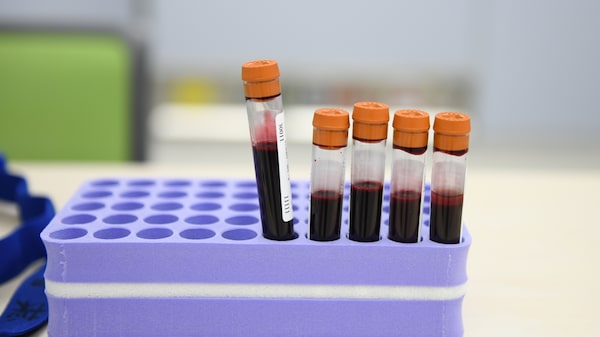 Análisis de sangre podría detectar Alzheimer años antes de que aparezcan síntomas Análisis de sangre podría detectar Alzheimer años antes de que aparezcan síntomas