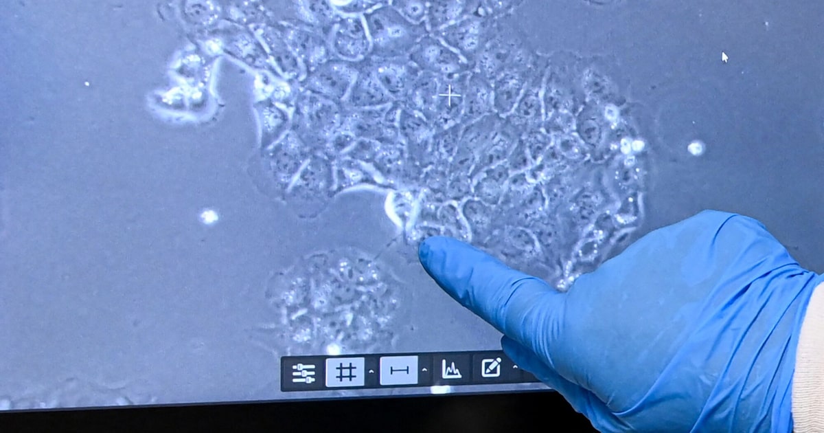 IA DETECTA CÁNCER DE PÁNCREAS TEMPRANO