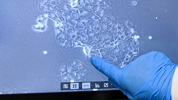 La IA logra detectar el cáncer de páncreas con más de un año de antelación La IA logra detectar el cáncer de páncreas con más de un año de antelación