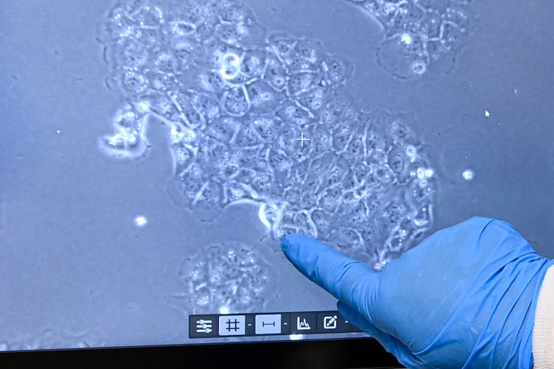 Una célula de cáncer de páncreas en una microfotografía que se muestra en una pantalla. Fotógrafo: Jean-François Monier/AFP/Getty Images Una célula de cáncer de páncreas en una microfotografía que se muestra en una pantalla. Fotógrafo: Jean-François Monier/AFP/Getty Images