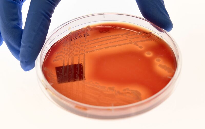 Superbugs Death Toll Could Swell by Millions Over Coming Years Superbugs Death Toll Could Swell by Millions Over Coming Years