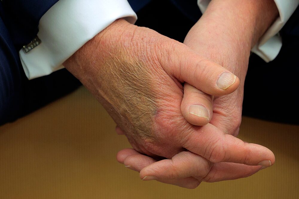 WASHINGTON, DC - FEBRUARY 24: Makeup covers a bruise on the back of U.S. President Donald Trump's hand as he hosts French President Emmanuel Macron for meetings at the White House on February 24, 2025 in Washington, DC. Macron is meeting with Trump in Washington on the third anniversary of Russia's full-scale military invasion of Ukraine. (Photo by Chip Somodevilla/Getty Images) WASHINGTON, DC - FEBRUARY 24: Makeup covers a bruise on the back of U.S. President Donald Trump's hand as he hosts French President Emmanuel Macron for meetings at the White House on February 24, 2025 in Washington, DC. Macron is meeting with Trump in Washington on the third anniversary of Russia's full-scale military invasion of Ukraine. (Photo by Chip Somodevilla/Getty Images)