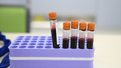 Comité de la FDA respalda prueba de sangre de Grail para detectar múltiples tipos de cáncer Comité de la FDA respalda prueba de sangre de Grail para detectar múltiples tipos de cáncer