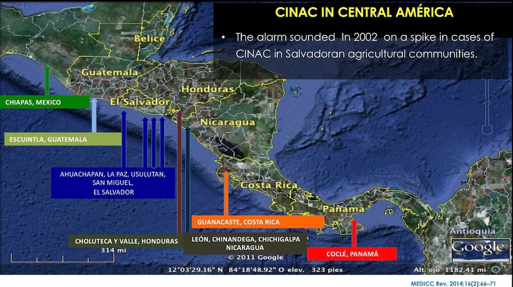 Un mapeo muestra las zonas más afectadas por la nefropatía mesoamericana, o también llamada nefritis intersticial crónica en comunidades agrícolas (CINAC), desde de México a Panamá. Un mapeo muestra las zonas más afectadas por la nefropatía mesoamericana, o también llamada nefritis intersticial crónica en comunidades agrícolas (CINAC), desde de México a Panamá.